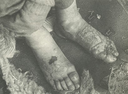 731部队的冻伤实验,受试者脚部病变惨状.
